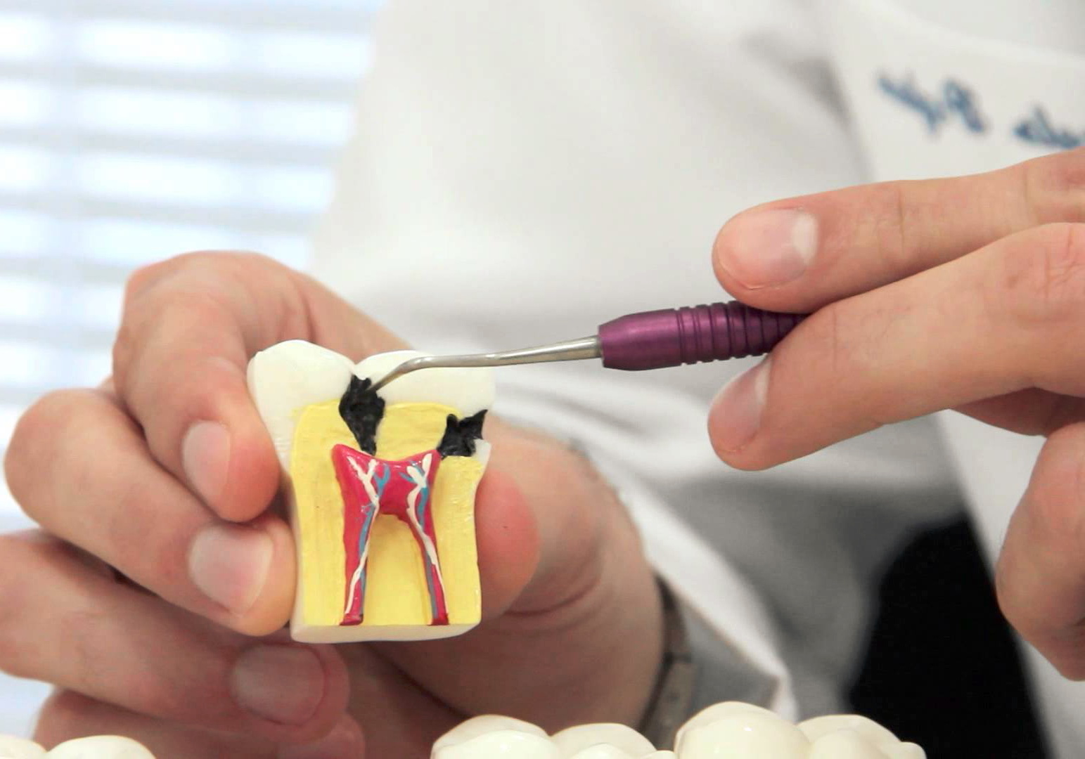 Лечение каналов зуба – что это такое