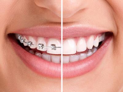 ортодонт, стоматолог-ортодонт, исправление зубов, выравнивание зубов, брекеты