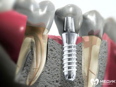 имплант, зубной имплантант, стоматолог-ортопед, имплантолог, Straumann